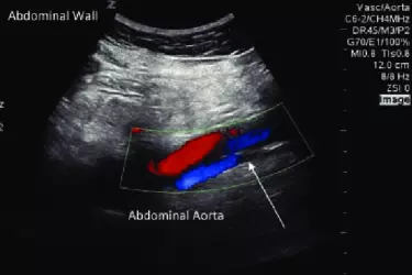 abdominal colour doppler, abdominal aortic aneurysm, colour doppler of aorta, cost of colour doppler of the abdominal aorta, best radiologist for colour doppler abdomen, best diagnostic centre in Bhiwadi