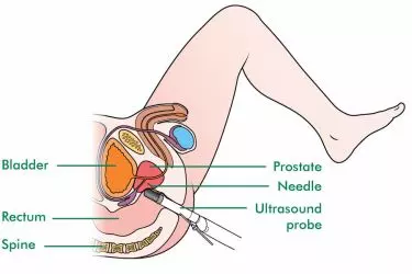transrectal ultrasound (trus) in Bhiwadi, cost of trus ultrasound in Bhiwadi, ultrasound for prostate cancer in Bhiwadi, ultrasound for colon cancer in Bhiwadi